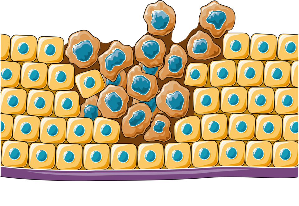 AI Discovers New Paths to Beating Cancer